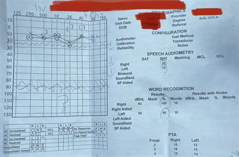 Is this a normal audiogram? : r/HearingLoss