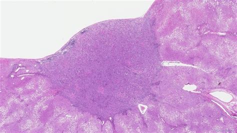 Bile Duct Adenoma Ottawa Atlas Of Pathology