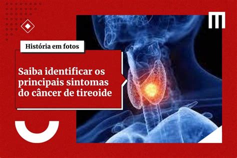 Aprenda A Reconhecer 7 Sinais Que Podem Indicar Problemas Na Tireoide