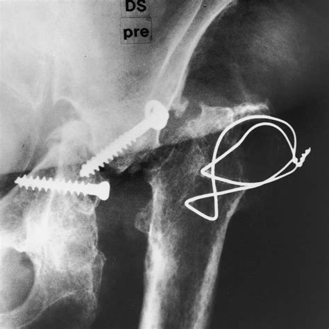 A Through 1 D The Patient Who Had Migration Of The Acetabular Download Scientific Diagram