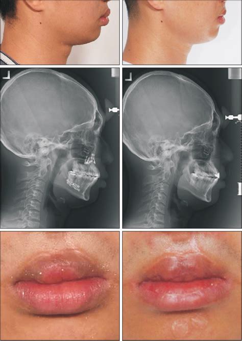 Figure 3 From Surgical Correction Of Cleft Lip Lower Lip Deformity A