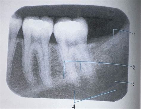 Radiographic Exam Flashcards Quizlet