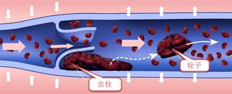 看图说肺——肺栓塞 微医（挂号网）