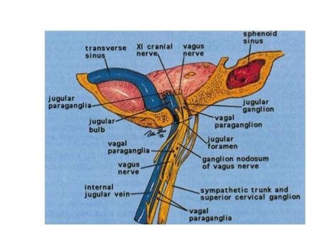 Head and neck paraganglioma