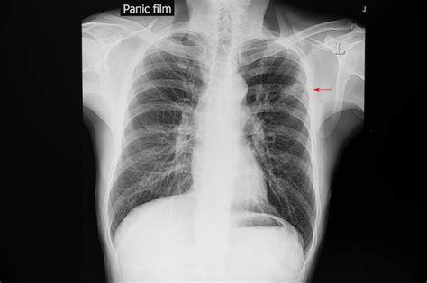 Radiografia De Torax Con Tuberculosis Image To U