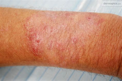 Skin Rash Fungal Infection Pictures At Sandra Torres Blog