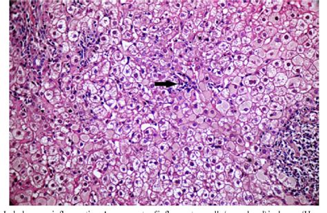 Table From Pathology Of Chronic Hepatitis B And Chronic Hepatitis C