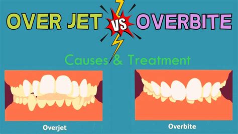 Overjet Vs Overbite Deep Bite Explained In 3 Minutes Youtube