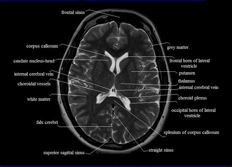 Mri Anatomy Free Mri Axial Brain Anatomy