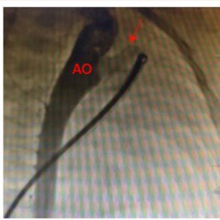 Transthoracic echocardiography results before occlusion. The white... | Download Scientific Diagram