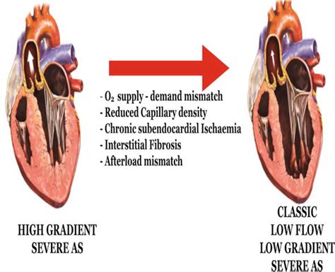 Famous Low Flow Low Gradient Aortic Stenosis Treatment Ideas ...