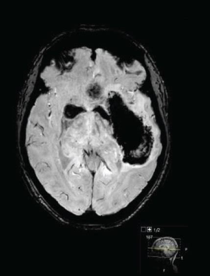 A Day 0 Initial CT Scan Presenting Left Hemispheric Intracranial