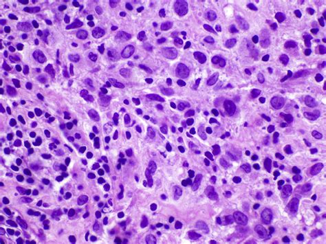 H E Lch Biopsy Langerhans Cell Histiocytosis Typical Cytologic