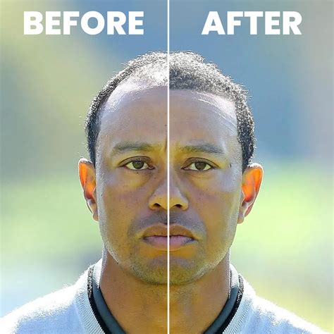 Tiger Woods With Hair Hair Transplant Simulation Result