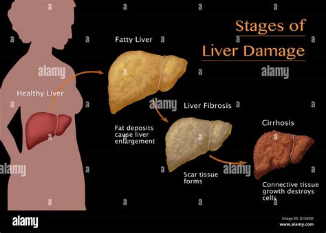 Stages of liver damage due to alcoholism. First alcohol compromises the ...