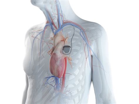 Pacemaker Insertion Pulse Cardiology Center