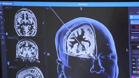 Brain Surgery Wallpaper