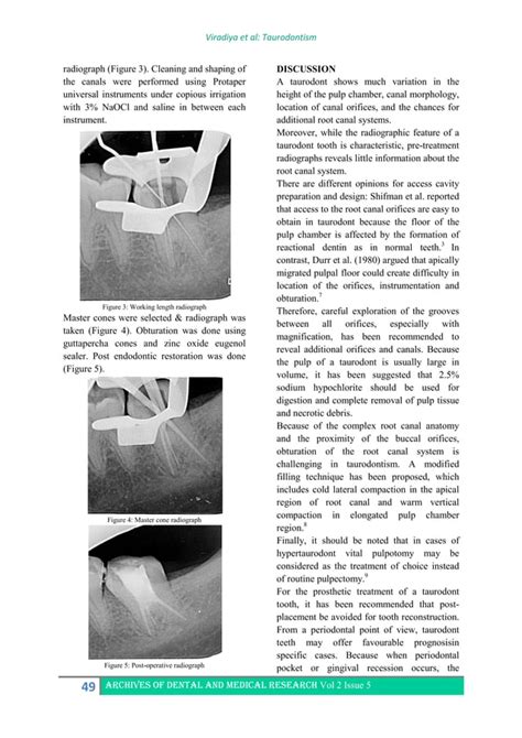 Case report on Taurodontism: A challenging anomaly