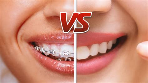 Clear Braces Vs Invisalign