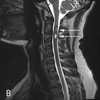 Sagittal T Weighted Mri At Patient Presentation A Three Week