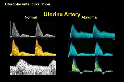 Color Doppler In Fetal Hypoxia PPT