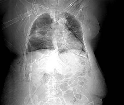 Barotrauma due to mechanical ventilation | Image | Radiopaedia.org