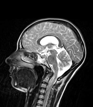 Closed Lip Schizencephaly Image Radiopaedia Org