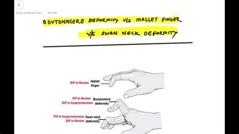 Easy Mnemonic For Swan Neck Deformity Mallet Finger Boutaunniere Deformity Neetpg Youtube