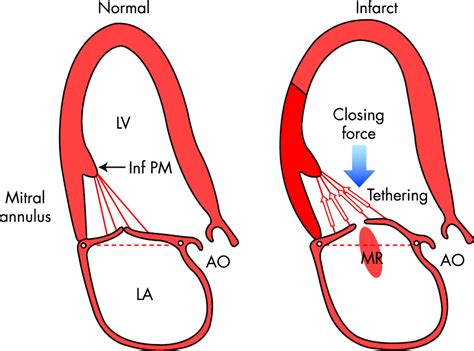 Management Of Ischaemic Mitral Regurgitation Heart