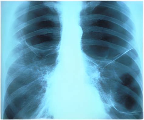 Chest X Ray Lung Cancer