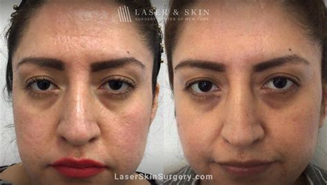 How To Treat Pitted Acne Scars And Boost Your Confidence Laser Ny