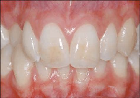 Preoperative Facial View Of The Patient S Teeth Showing Significant Download Scientific Diagram