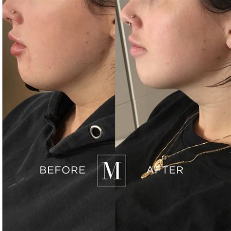 Belkyra™ Double Chin Treatment — Monaco Medical Aesthetics