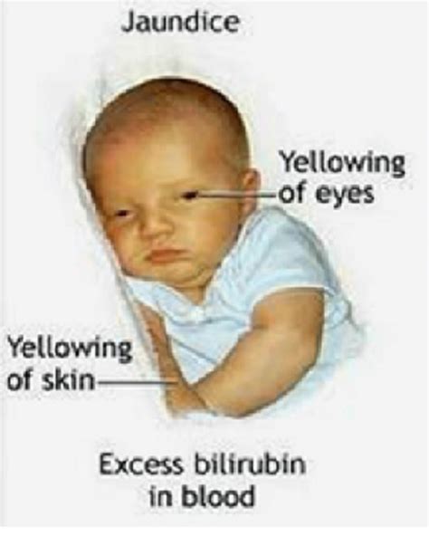 Ikterus Neonatorum Gejala Penyebab Dan Cara Mengobati Idn Medis