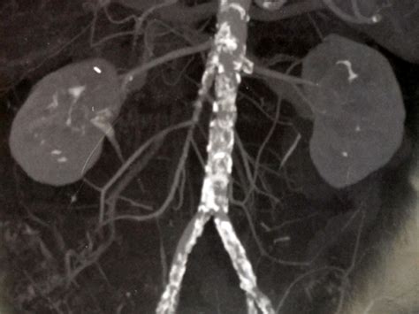 Axillobifemoral Bypass Vascular And Vein