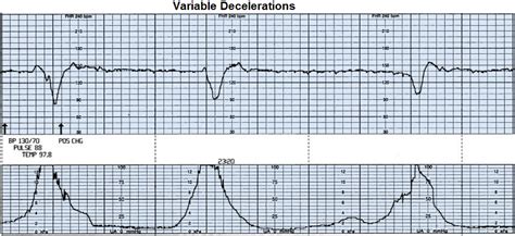 Variable Decelerations- Explained