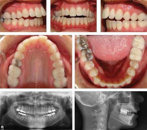 Class Ii Malocclusion Correction With Invisalign Is It Possible Clair Alston