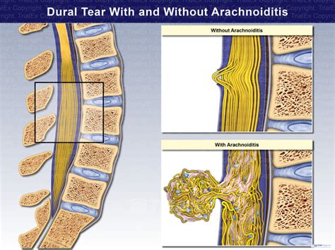 Dural Tear With and Without Arachnoiditis - TrialExhibits Inc.