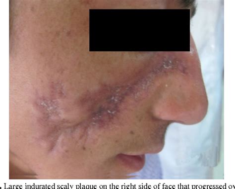 Figure From Unusual Manifestation Of Cutaneous Sarcoidosis A Case