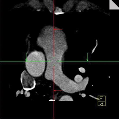 Sex Specific Normalized Reference Values Of Heart And Great Vessel