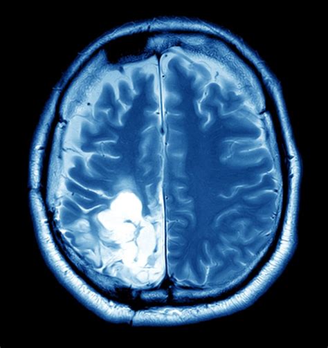 Brain tumor Guide: Causes, Symptoms and Treatment Options