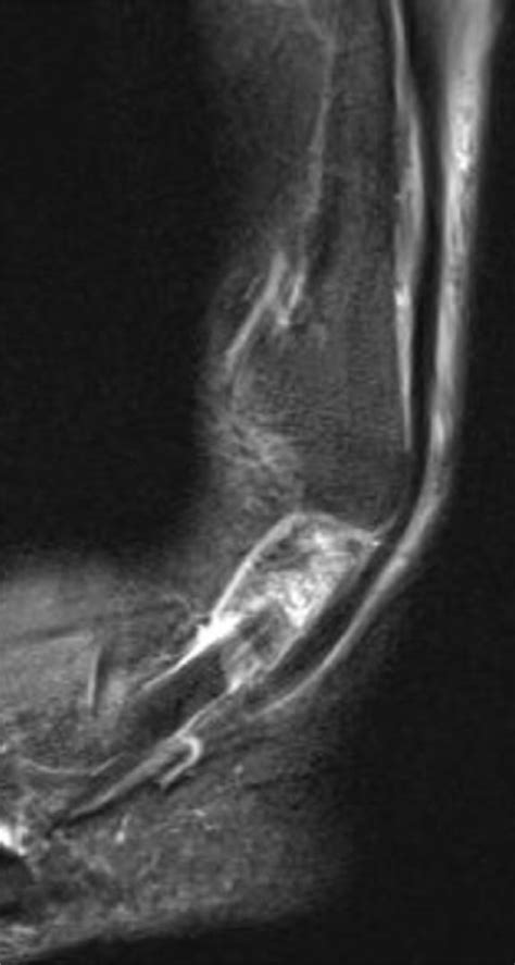 Rupture of the peroneus brevis tendon (MRI oblique axial view). | Download Scientific Diagram