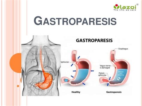 Gastroparesis Causes Symptoms Diagnosis And Treatment