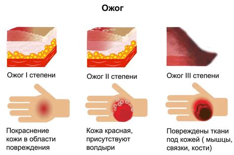 Что такое урина от ожогов фото презентация