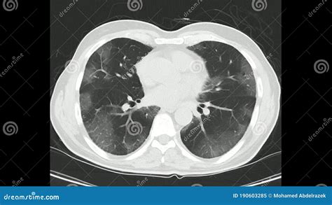 Computed Tomography Of The Chest High Resolution CT Chest In A