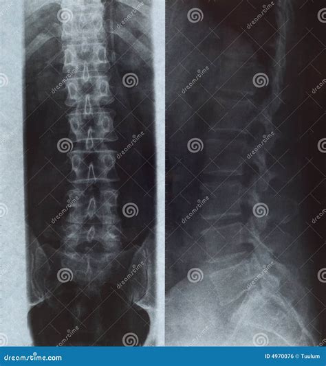 人力脊椎x 射线 库存照片 图片 包括有 脊椎 脊髓 紧急 爱好健美者 上面 光芒 椎骨 医院 4970076
