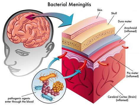 What is the Difference Between Sepsis and Meningitis?