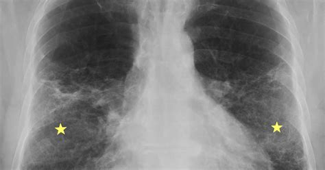 Rit Radiology Acute Exacerbation Of Idiopathic Pulmonary Fibrosis