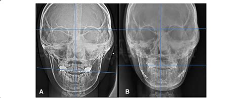 Preoperative A And 2 Years Postoperative Radiographic Image B Of Download Scientific