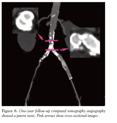 Kissing Iliac Artery Stent Technique for Salvage of a Total Occlusion ...